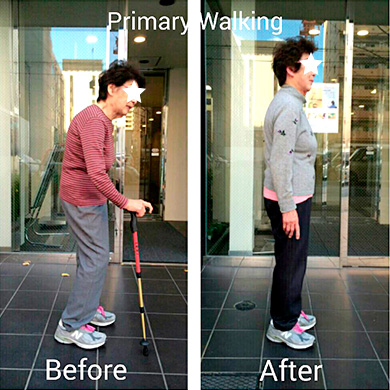 Aさん(74歳 女性) ◆ 脊椎の圧迫骨折