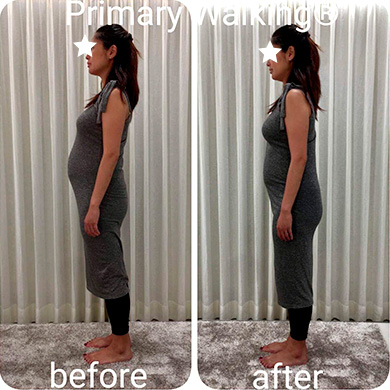 Ｍさん(24歳 女性) ◆ 姿勢等の改善