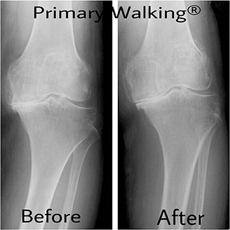 その他・膝の故障